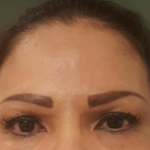 Brow Lift - Before