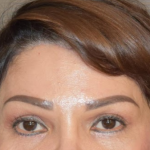 Brow Lift - After