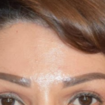 Brow Lift - After