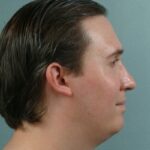 Chin Surgery - Before