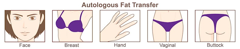 Graphic of Autologous Fat Transfer on a female body