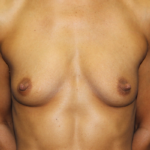 Breast Augmentation 350cc Silicone Before Front View