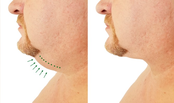 Before and After: Neck and Jawline liposuction in Denver CO