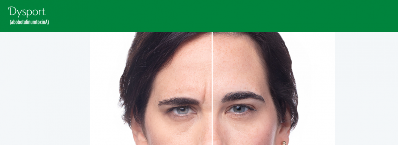 Photo: Dysport Difference - Before and After Facial Wrinkle Treatment in Denver CO