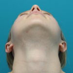 Otoplasty After Aerial