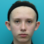 Otoplasty Before Front View