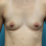 Breast Augmentation 340cc Silicone Extra High Profile Before Front View