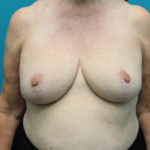 Breast Lift After Front View