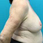 Breast Lift After Right Side View