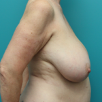 Breast Lift Before Right Side View