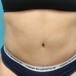 Tummy Tuck With Waist Lipo - After