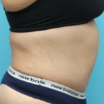 Tummy Tuck With Waist Lipo - After