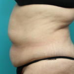 Tummy Tuck With Waist Lipo - Before