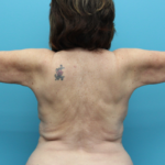 Arm Lipo After Back