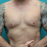 Before Gynecomastia Front View