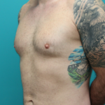 Before Gynecomastia Left Side Angled View