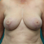 Breast Reduction After Front View
