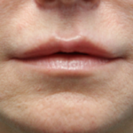 Lip Lift After Front View