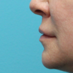 Lip Lift After Left Side View