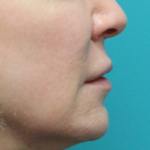 Lip Lift After Right Side View