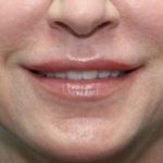 Lip Lift After Smiling