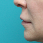 Lip Lift Before Left Side View