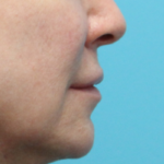Lip Lift Before Right Side View