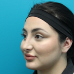 Rhinoplasty After Left Side Angled View