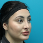 Rhinoplasty After Right Side Angled View