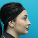Rhinoplasty After Right Side View