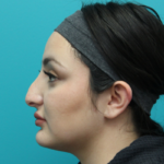 Rhinoplasty Before Left Side View