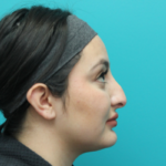 Rhinoplasty Before Right Side View