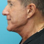 After Lower Face and Necklift w Blepharoplasty Left Side View