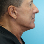 After Lower Face and Necklift w Blepharoplasty RightSide View
