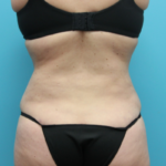 After Tummy Tuck Back View