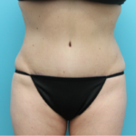 After Tummy Tuck Front View