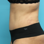 After Tummy Tuck Left Side View