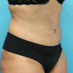 After Tummy Tuck Right SIde Angled View