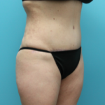 After Tummy Tuck Right Side Angled View