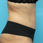 After Tummy Tuck Right Side vVew