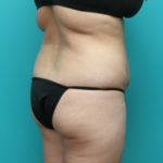 Before Tummy Tuck Back Angled View