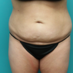 Before Tummy Tuck Front View