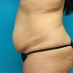 Before Tummy Tuck Left Side View