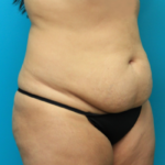 Before Tummy Tuck Right Side Angled View