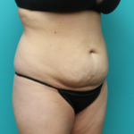 Before Tummy Tuck Right Side Angled View