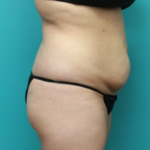 Before Tummy Tuck Right Side View