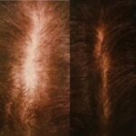 Before and After Hair Regeneration Photo