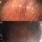 Before and After Hair Regeneration images