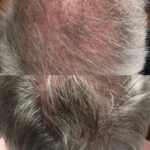 Image of Before and After Hair Regeneration