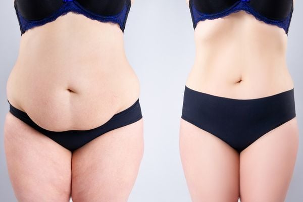 image of before and after a tummy tuck